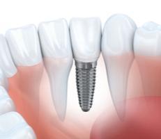 Dental Implants