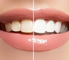 Teeth Whitening